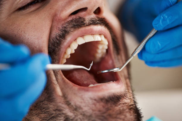Best Emergency Tooth Extraction in Pinconning, MI